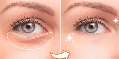 eye bags removal